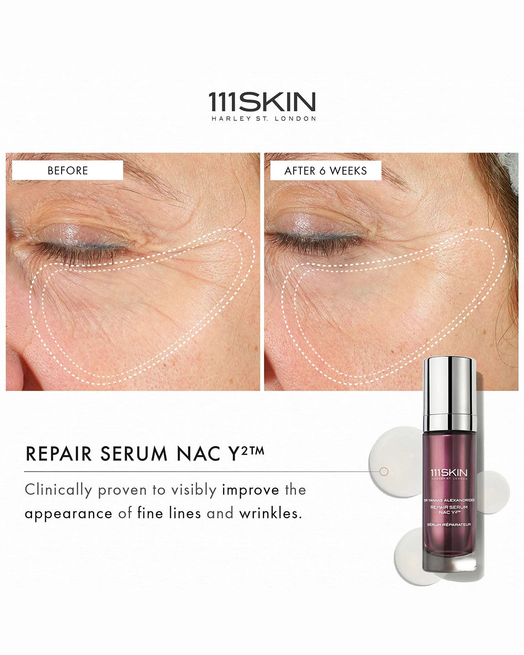 111SKIN repair serum advertisement showing before and after effects on skin.