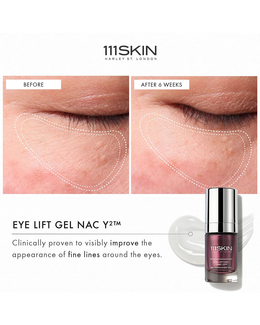 Before and after comparison of eye lift gel with 111SKIN branding.