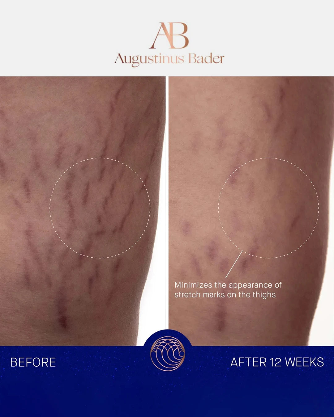 Before and after comparison of stretch marks on thighs with Augustinus Bader branding.