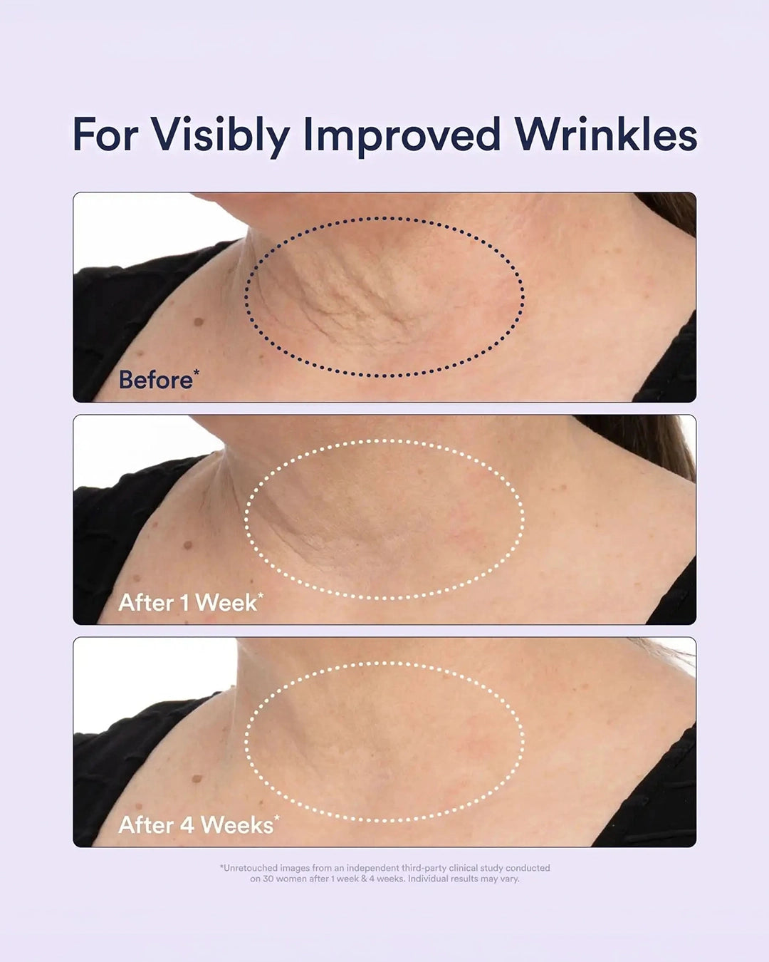 Before and after comparison of visibly improved wrinkles on a person's neck.