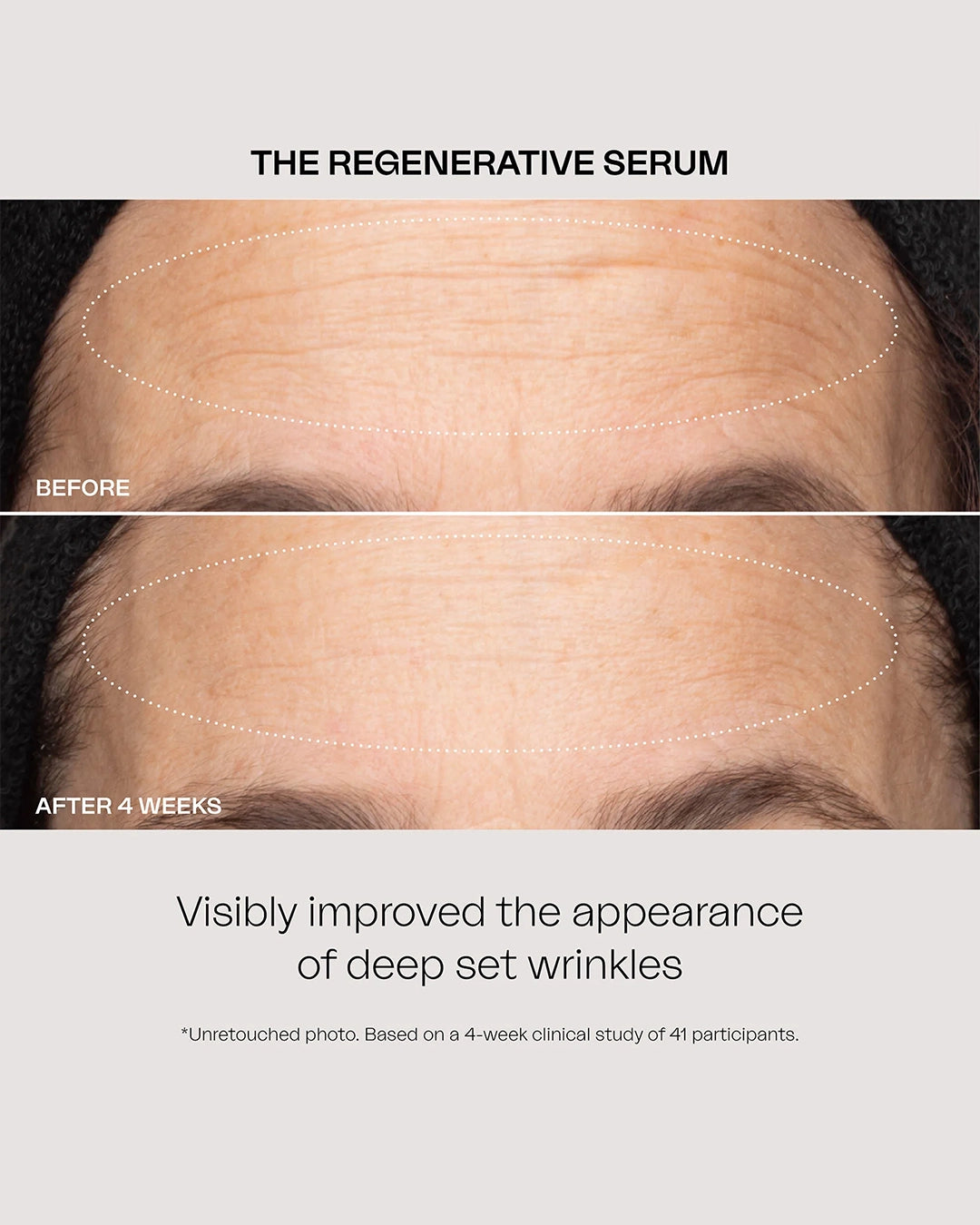 Before and after comparison of deep set wrinkles on a person's forehead with text about a regenerative serum.