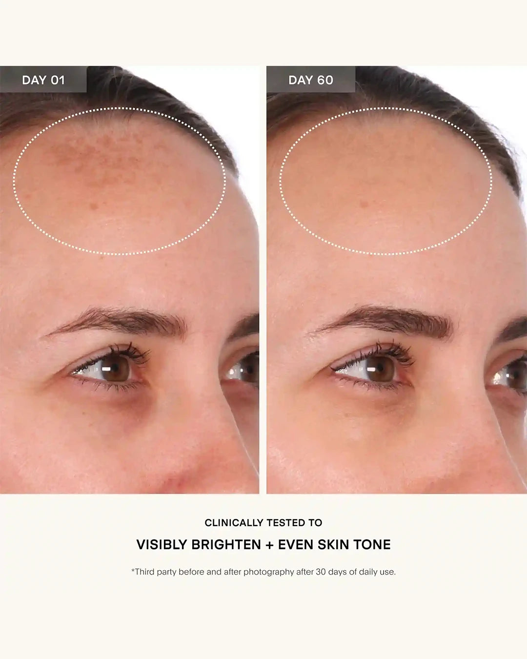 Before and after skin treatment showing visible improvement on a person's face.