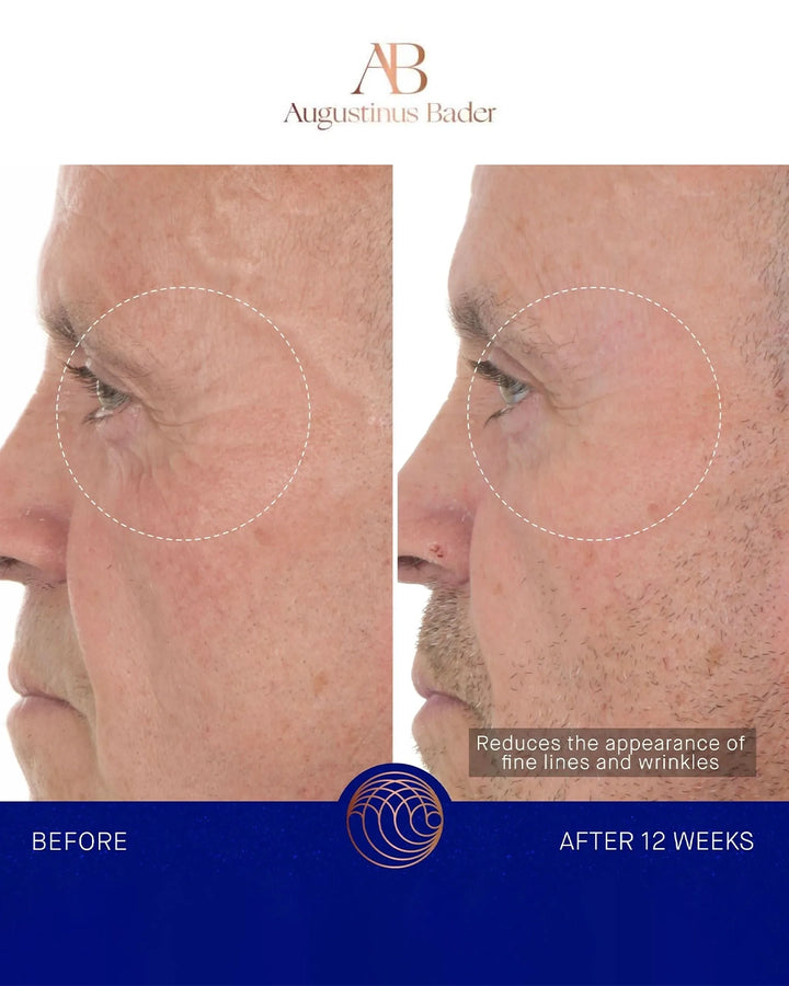 Before and after comparison of facial skin treatment by Augustinus Bader, showing reduced appearance of fine lines and wrinkles.