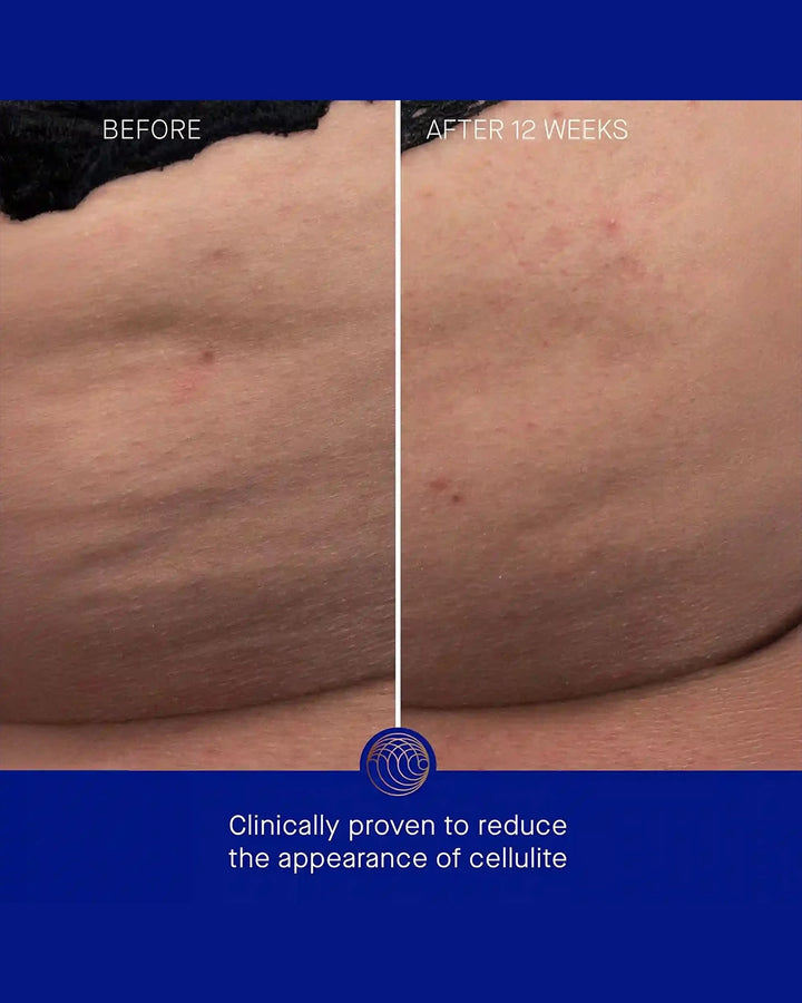 Before and after comparison of cellulite reduction on skin with a blue border.