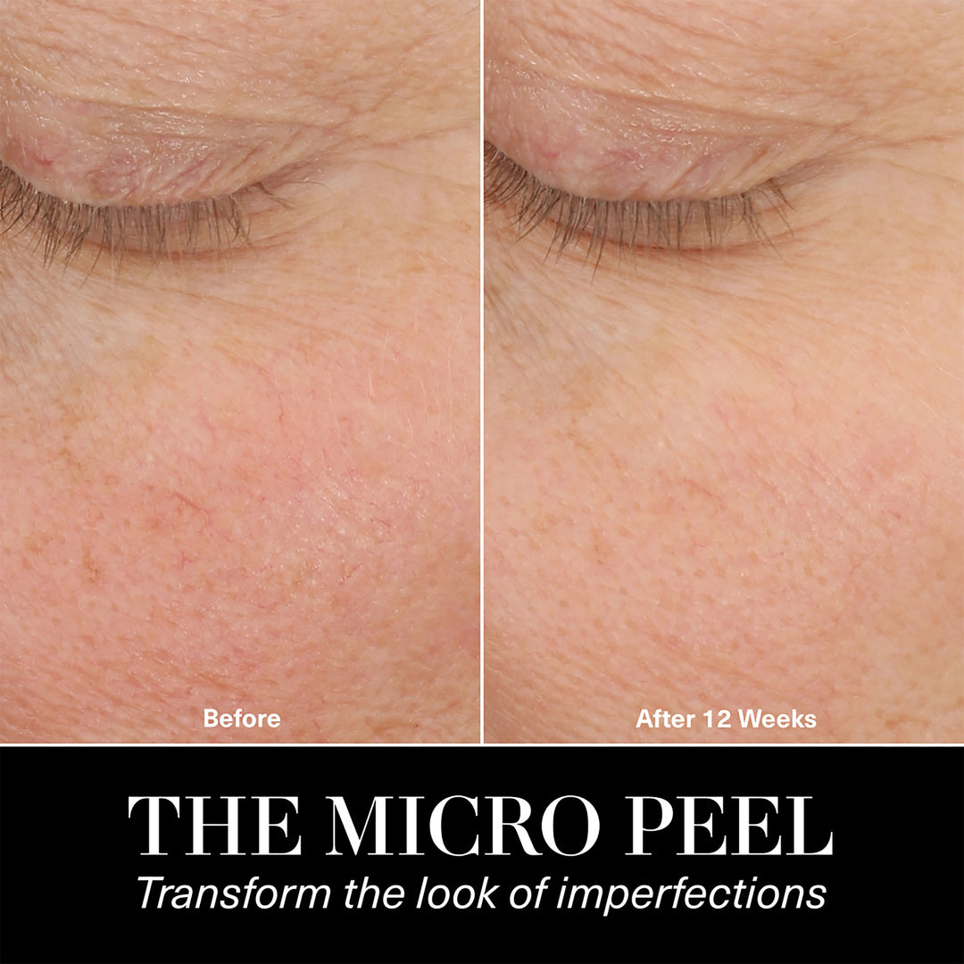 The Micro Peel