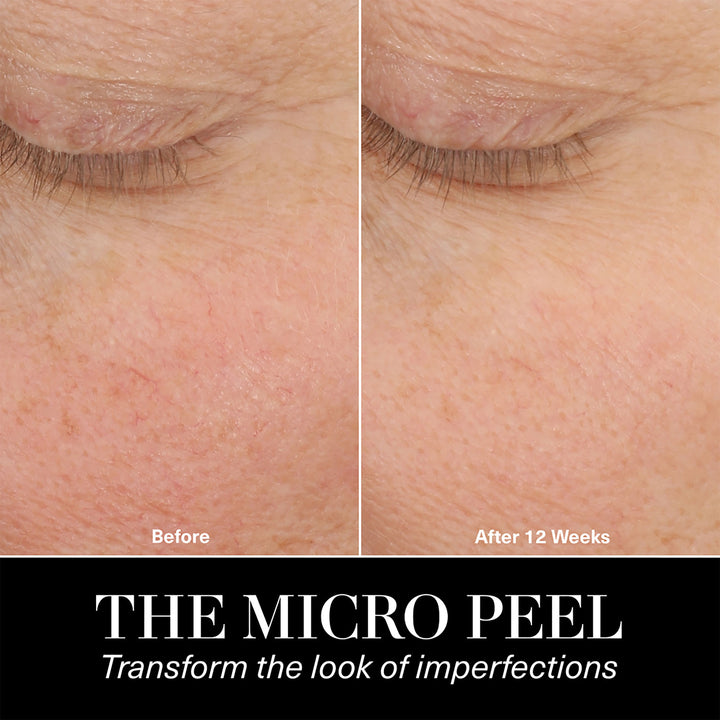 The Micro Peel